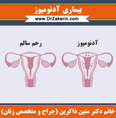 بیماری آدنومیوز
