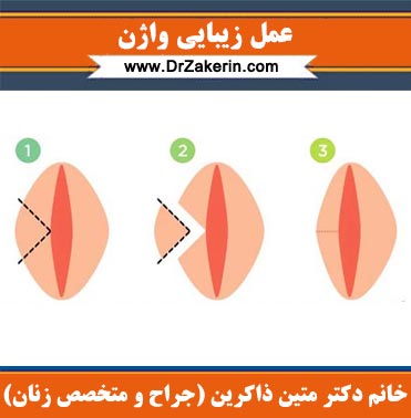 عکس عمل زیبایی واژن