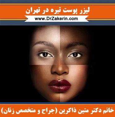 لیزر پوست تیره در تهران